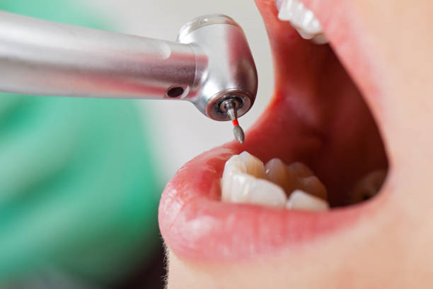 Best Emergency Dental Extractions in Charlotte, NC